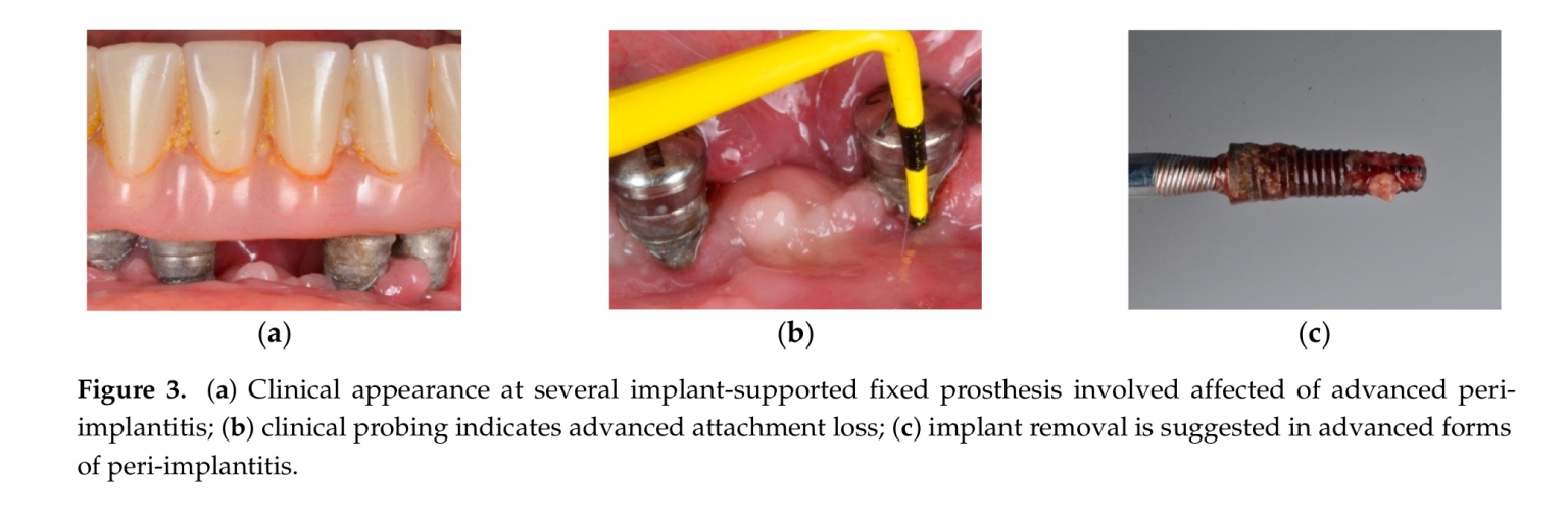 Peri-Implantitis: A Clinical Update On Prevalence And Surgical – Aladent